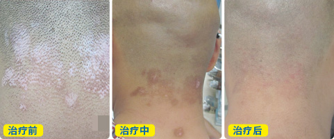 肉眼看白癜风黑色素长满了可以只吃药恢复吗