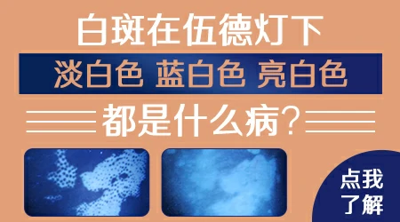 做伍德灯白斑是淡白色