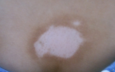 肚子上白斑治疗半年了效果不太好有什么办法吗