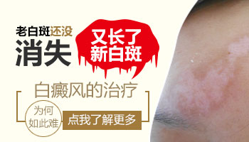 白癜风在治疗过程中有新出的白斑怎么办