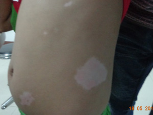 男性腿和肚子上的白斑一年了不疼不痒怎么回事