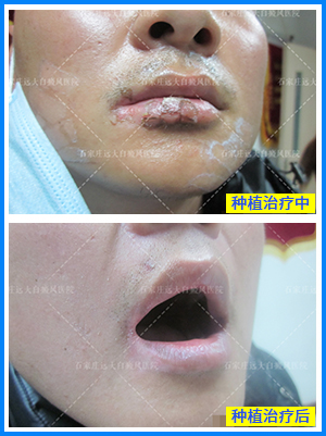 免疫力低引起的白癜风怎么治疗