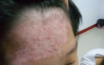 额头上的白癜风越来越多