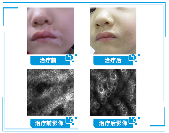 6.25世界白癜风日—“拒绝歧视,共抗白斑”普查援助活动