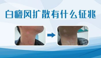 嘴唇白癜风初期是不是特别的慢