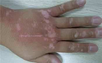 手背白斑初期症状有哪些 「疾病问答」