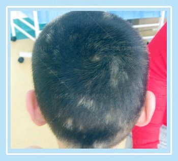 头皮白癜风头发变白用光疗治疗后头发能变黑吗