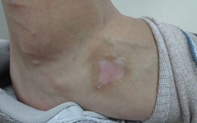 脚面烫伤成了白癜风做种植成功率高吗