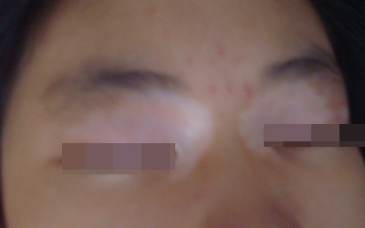 眼角两侧出现对称白斑