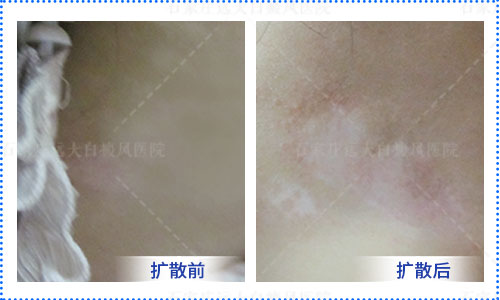 白癜风的白斑会凸起来吗 早期白斑症状表现