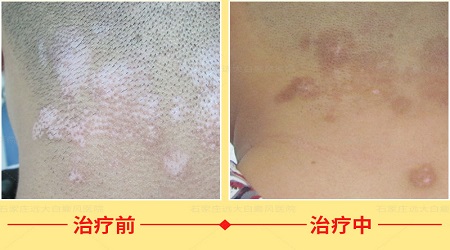 紫外线光疗仪治白癜风有用吗