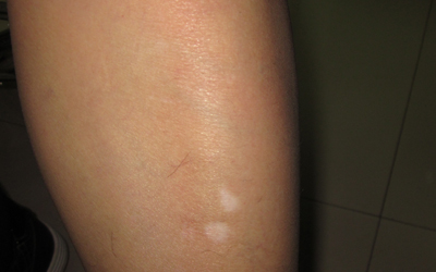 白癜风早期常常以白斑,白点,白块的形态出现在患者身上,出现的部位不