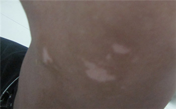 4个月宝宝背部白斑图