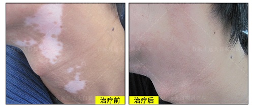 石家庄口碑比较好的白癜风医院是哪家