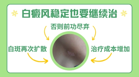 白斑边界从模糊变清晰代表进入稳定期了吗