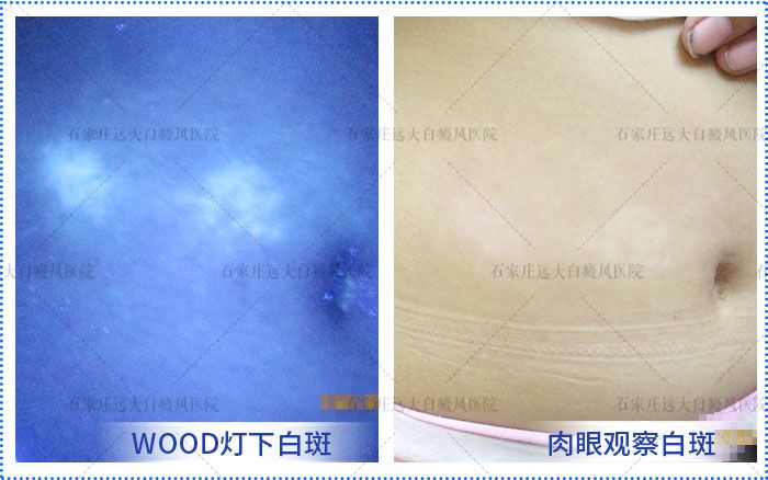 宝宝肚皮上有白点图片