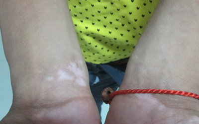 孩子胳膊上有白点图片