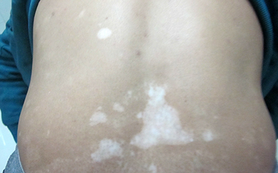 背部白癜风摸着应该是光滑的还是粗糙的