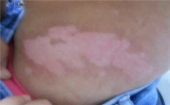 皮肤上有大块白斑
