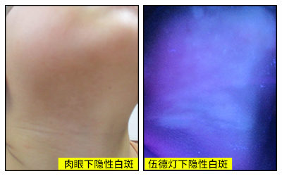 隐形白癜风发病机率