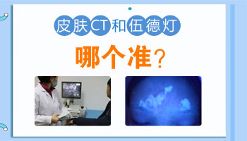 伍德灯检查早期的白癜风准确率高吗