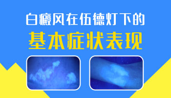 白癜风用Wood灯照射后是什么颜色