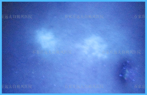 儿童皮肤白点伍德灯检查边界不清呈弱阳性