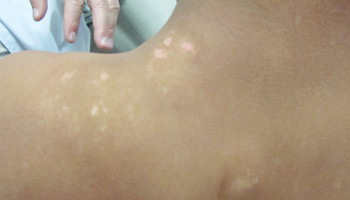 孩子后背上白了一块是怎么回事