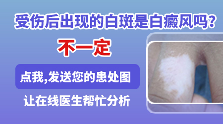 复发型白癜风能治好吗 摔伤为什么会引发白癜风