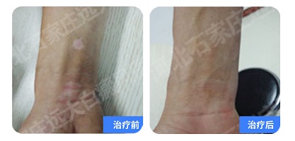 白癜风涂药之后肿起来了怎么办