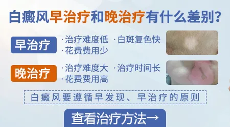 手背关节处白癜风ZUI初征兆图片