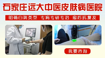 衡水看白癜风怎么样 能治好吗