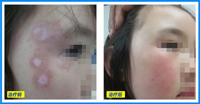 白癜风完全治愈案例 真的有治好白癜风的吗