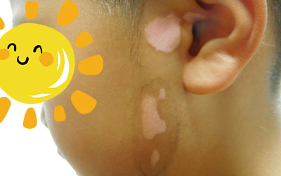 小孩身上出现几块白色是什么