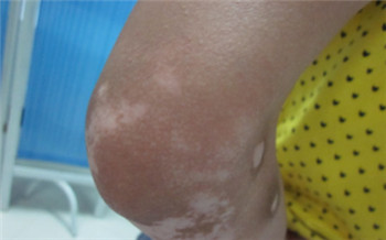 白癜风用手掐会变红吗 早期白癜风图片