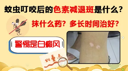 蚊子咬后留下白斑不褪怎么办