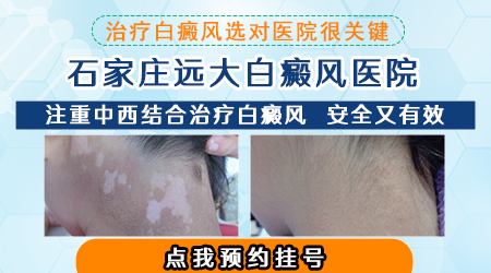 老中医能治好白癜风吗