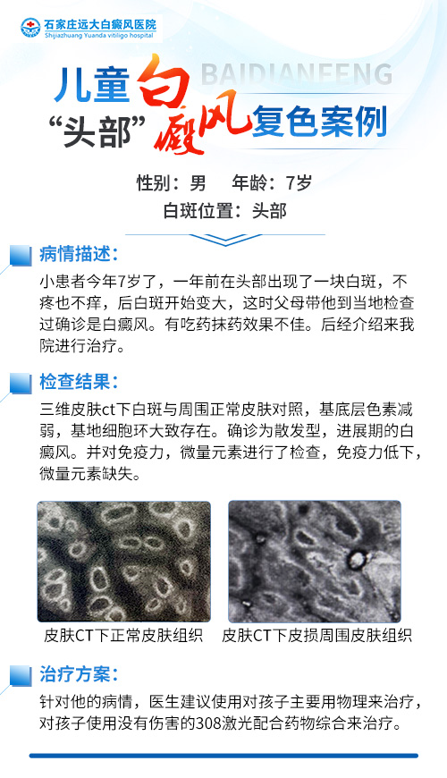 头部白斑一年多了怎么治疗好