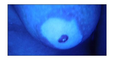 乳房下面长了一小块白点