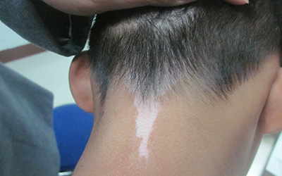 小孩脖子白斑初期图片