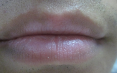 嘴唇下面的皮肤比其他部位白一些怎么回事