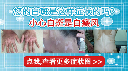 什么样的白斑是白癜风 早期白斑能治好吗