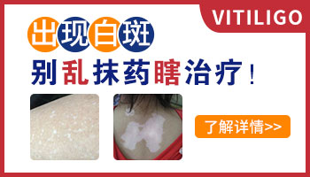 女性白癜风抹药后增多怎么治