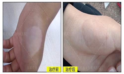 烫伤型白癜风可以用308激光治疗好吗