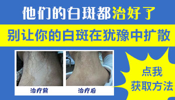 白癜风一星期扩散多少