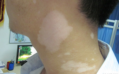 颈部出现白点是怎么了 [身上长白斑的原因]