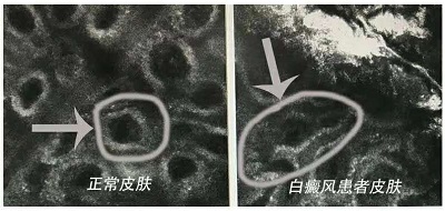 白癜风初期图片特点是什么