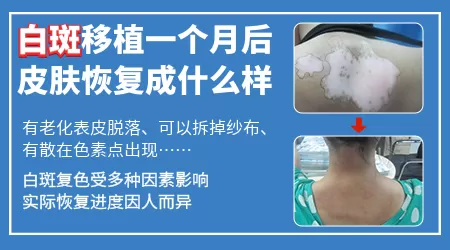 白癜风黑色素种植一个月后的照片
