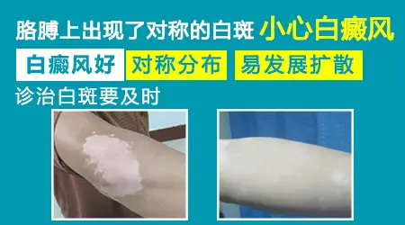 小孩胳膊上有白斑图片