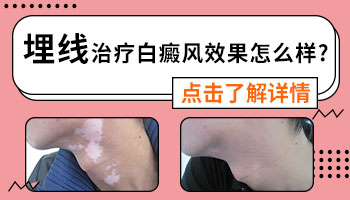 中医埋线治疗白癜风效果好吗